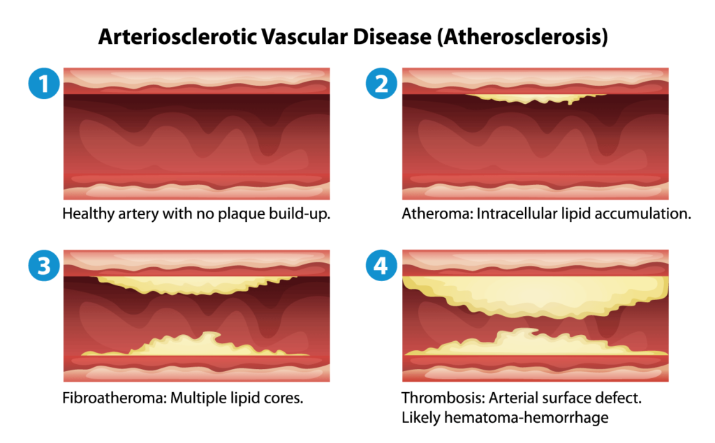 Is it possible to stop heart disease? healthy lives can minimize atherosclerosis.